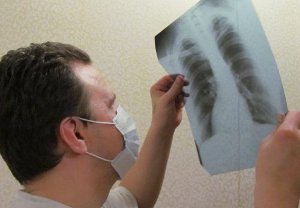В Сумах обострилась ситуация с туберкулезом — есть случай среди детей