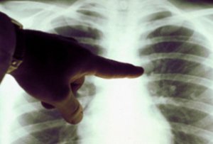 Специалисты рассказали о борьбе с туберкулезом в городе Сумы